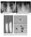 Coccidioidomycosis: an unusual cause of acute respiratory distress syndrome